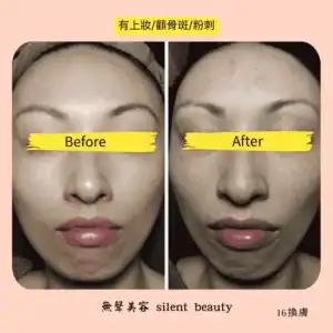 makeup pigmentation acne care before after