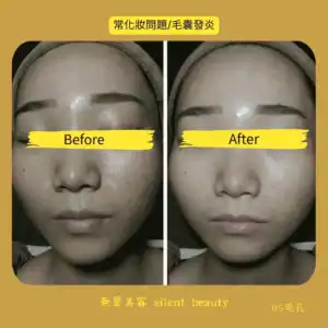 makeup related folliculitis pore care