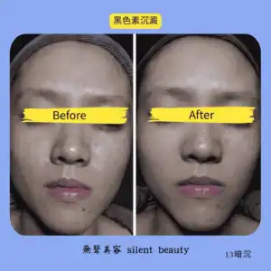 melanin dark spots facial brightening