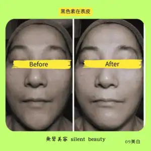 melanin epidermis whitening treatment