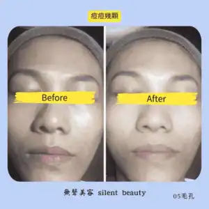 mild acne faded gentle result