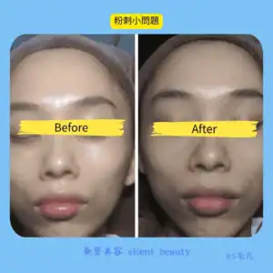 mild acne minor true improvement