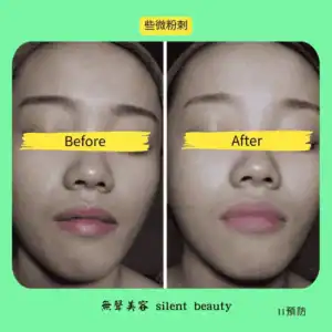 mild blackheads prevention skincare 11