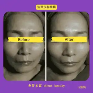 mild sebum buildup prevention facial