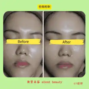 minor comedones skin clarity change