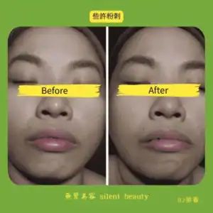 multiple whiteheads extraction purifying