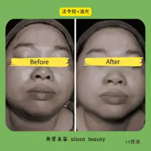nasolabial lines oily skin improvement 14