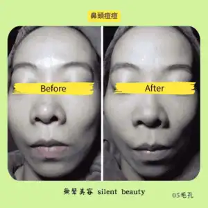 nose acne clearance case 05