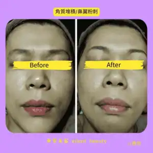 nose clogged pores keratin removal