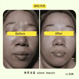 oily skin inner acne deep cleansing