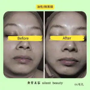 oily skin mild blackheads pores cleaning