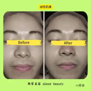 oily skin nose cleared pore free
