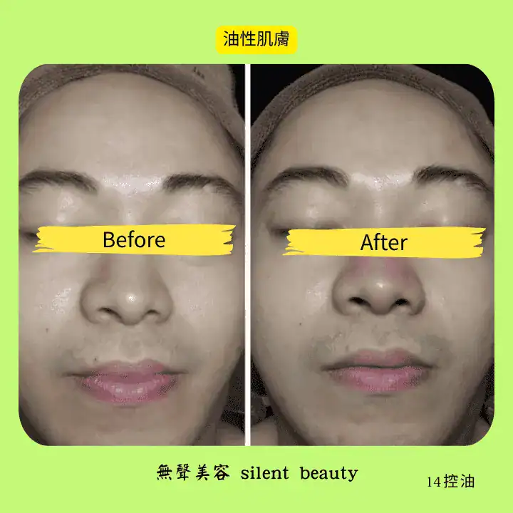oily skin nose cleared pore free