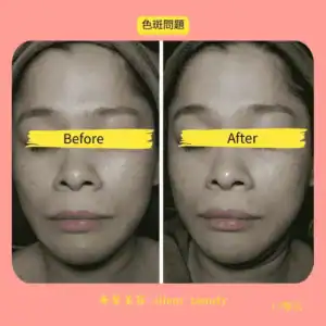 pigmentation spots treatment brightening