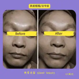 rough skin nasolabial lines treatment