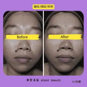 sensitive fine lines blackheads improvement 03
