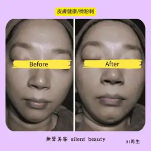 skin health micro acne repair