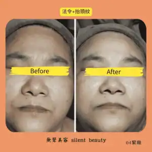 smile forehead wrinkle repair