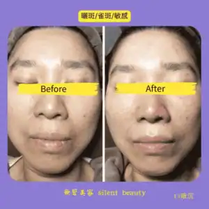 sun spots freckles sensitive skin care