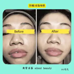 sunscreen sebum clogged pores treatment