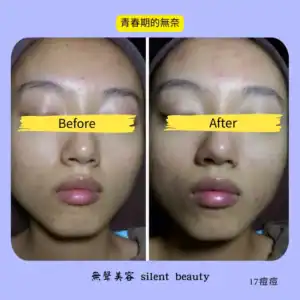 teen acne purging initial stage 17