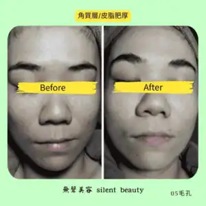 thick keratin oily skin pores treatment