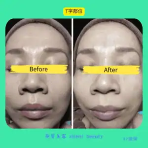 tzone oil improve before after