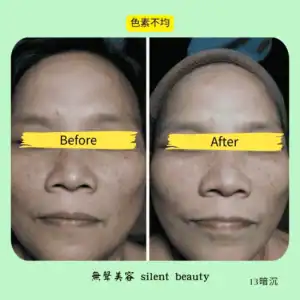 uneven skin tone evened change