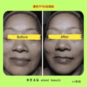 uneven tone smile lines treatment
