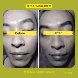 uneven tone thick keratin layer treatment