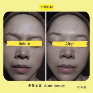 whitehead clear skin smoother