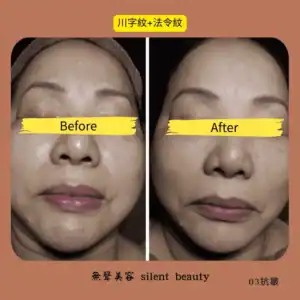 wrinkle nasolabial folds reduction 03