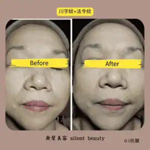 wrinkle nasolabial lines visible reduction 03