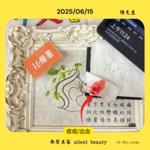 Facial acne bleeding with gauze on June 15, 2025, real skincare record