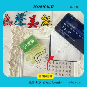 Blackhead and pustule extraction with gauze on June 17, 2025, real facial treatment record.