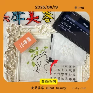 Whiteheads extraction with gauze on June 19, 2025, real facial care by Li.