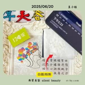 Darkness area whitehead extraction with gauze on June 20, 2025, real facial treatment.