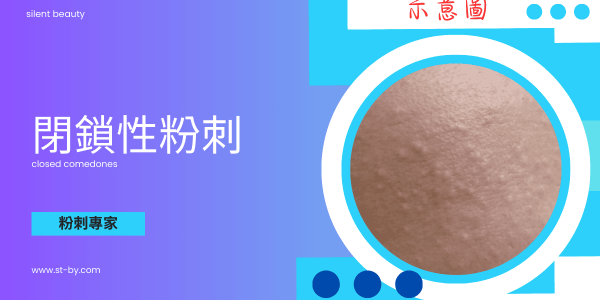 內包型粉刺除粉刺專家